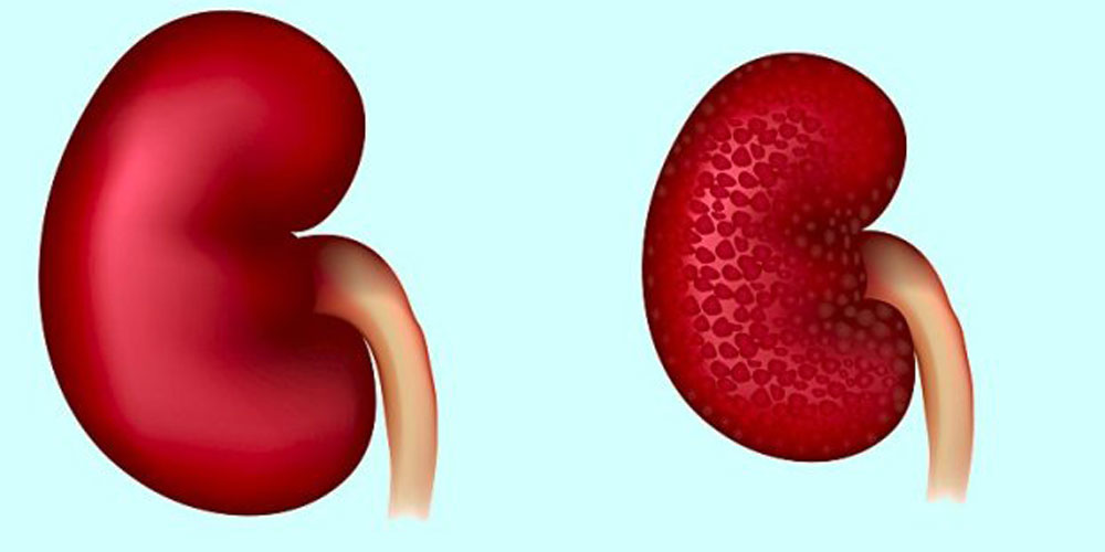 diabetic_nephropathy